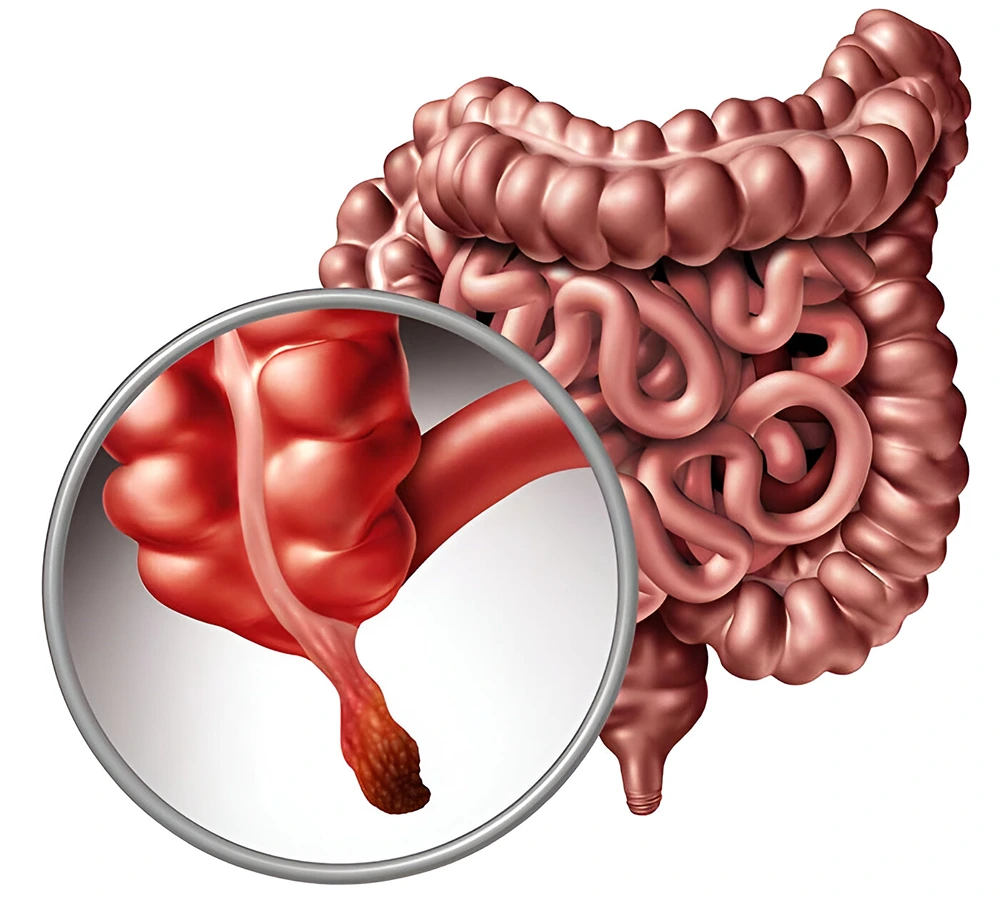 Max-Hospital-Faridabad-Appendicitis-2