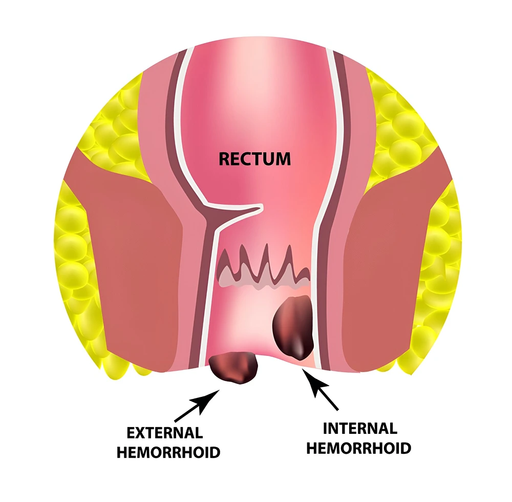 Max-Hospital-Faridabad-Pile-Haemorrhoids-2