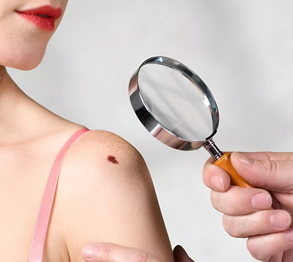 Max-Hospital-Faridabad-Skin-Lesions-2